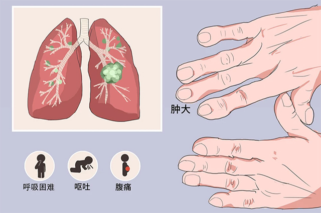 中医对肺肿瘤病因病机认识及临床表现观察