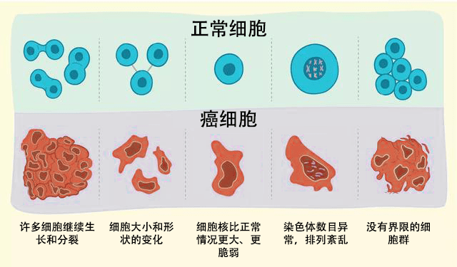 中分化肿瘤属于几期？怎么判断病情严重性？