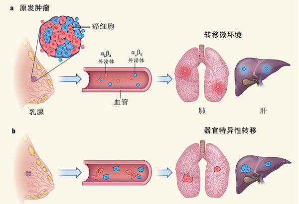 名老中医：肿瘤转移有何条件？如何分类？偏爱哪些部位？