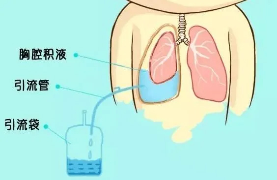 肺瘤容易出现胸腔积液吗？哪些症状提示可能有胸腔积液了呢？