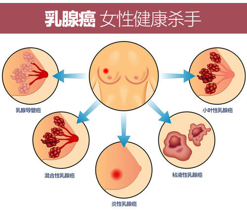 女性怎样远离乳腺癌？